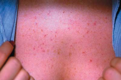 Folliculitis Part I Folliculitis Part I
