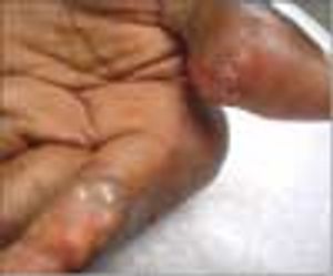 Chronic Tophaceous Gout