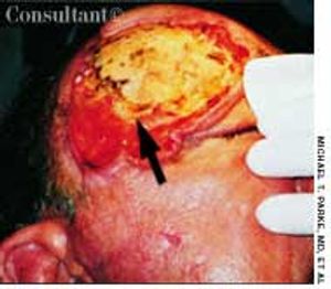 Metastatic Squamous Cell Carcinoma