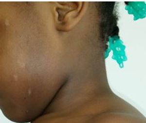 A Rash of Rough Spinous Patches on a Young Girl 