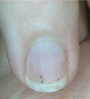 Do These Small Subungual Lines Suggest a Larger Problem? 