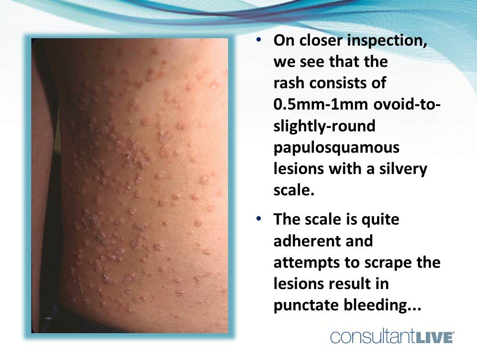 A Young Male with a Rash of Scales