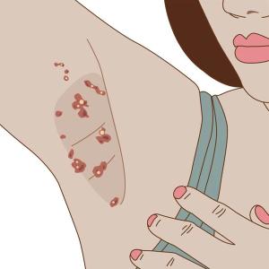 Hidradenitis Suppurativa: Recognition, Staging, and Management in Primary Care/ image credit ©grafixme/stock.adobe.com