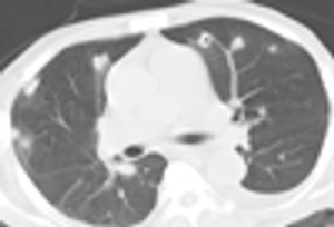 Fever, Dyspnea, and Pleuritic Chest Pain in a Man Started on Hemodyalisis
