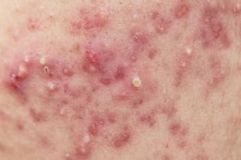 Does Obesity Cause Acne? New Study, Surprising Results, obesity and acne, skin