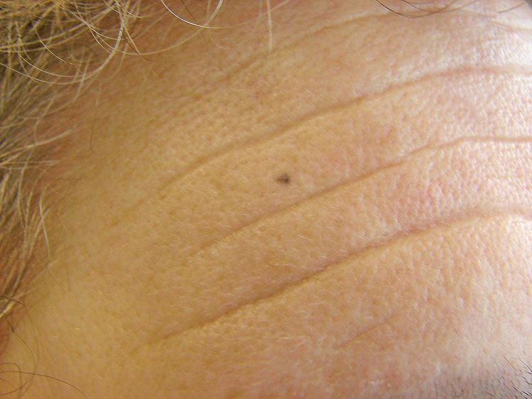 Black Spots On Forehead