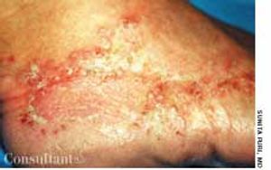 Dermatitis Caused by Shoes