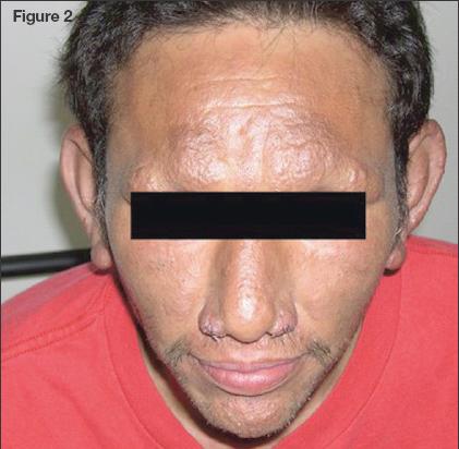 Hansen Disease (Leprosy)