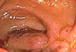 Inflammatory Bowel Disease: 5 Things Primary Care Doctors Need to Know Now