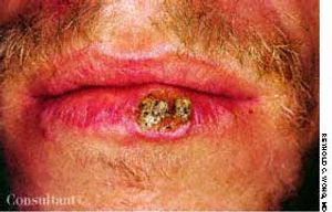 Squamous Cell Carcinoma of the Lip