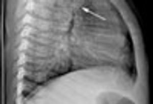 Double Aortic Arch in an Infant With Persistent Stridor