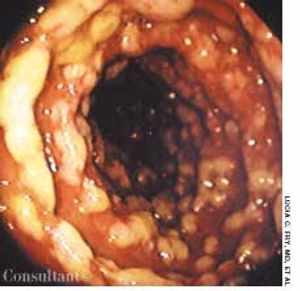 Pseudomembranous Enterocolitis in a Woman With Hypertension, Diabetes Mellitus, and Congestive Heart Failure