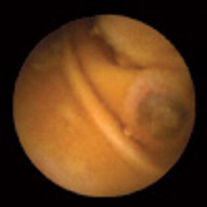 Small-Bowel Metastatic Melanoma
