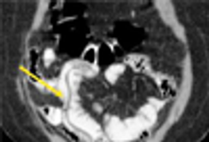 Helminthiasis Presenting as Microcytic Anemia