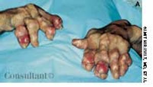 Gout