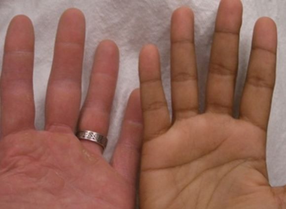 Addison S Disease Addison S Disease