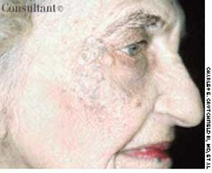 Favre-Racouchot Syndrome