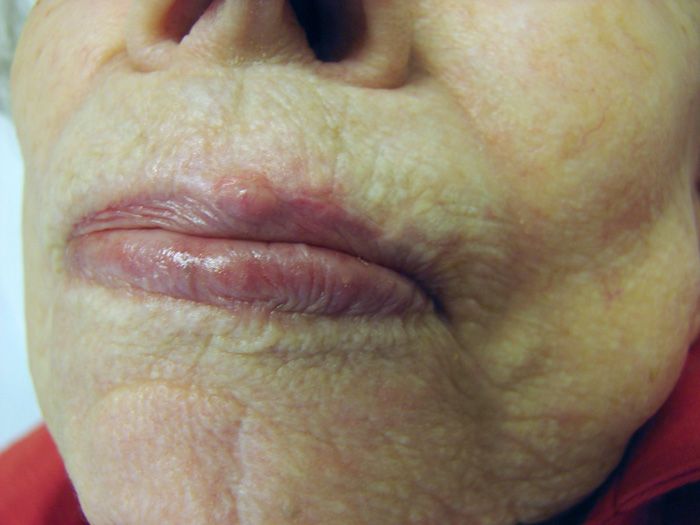 Skin Cancer On Lips Images