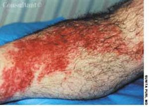 Erysipelas in a 60-Year-Old Man