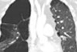 Giant Bullous Emphysema