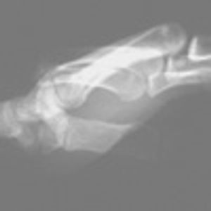 Dorsal Dislocation of the Fourth and Fifth Metacarpals