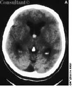 Colloid Cyst