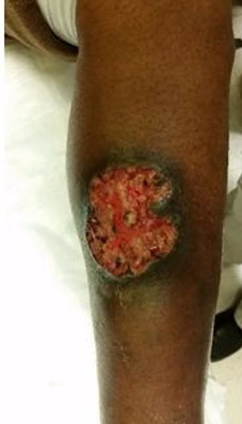 Pyoderma gangrenosum