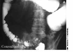 Urgent Care Needed Understanding Colovesical Fistula Emergencies - 1lhd0lo