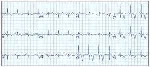 The Devil is in the T Wave