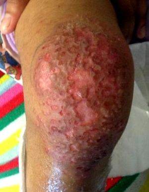 Eczema Herpeticum in a 4-Year-Old Girl