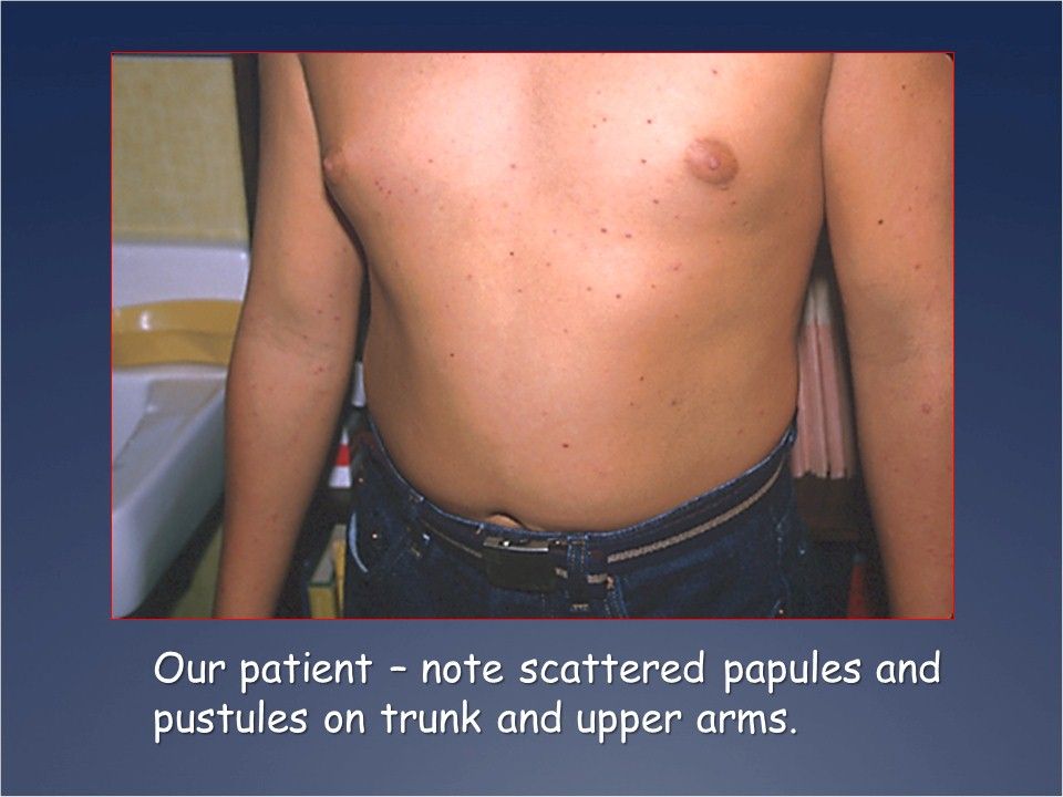 What are these scattered papules and pustules on trunk and upper arms.