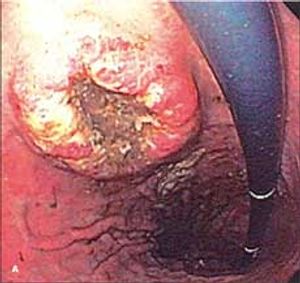 Multiple Myeloma With a Gastric Plasmacytoma