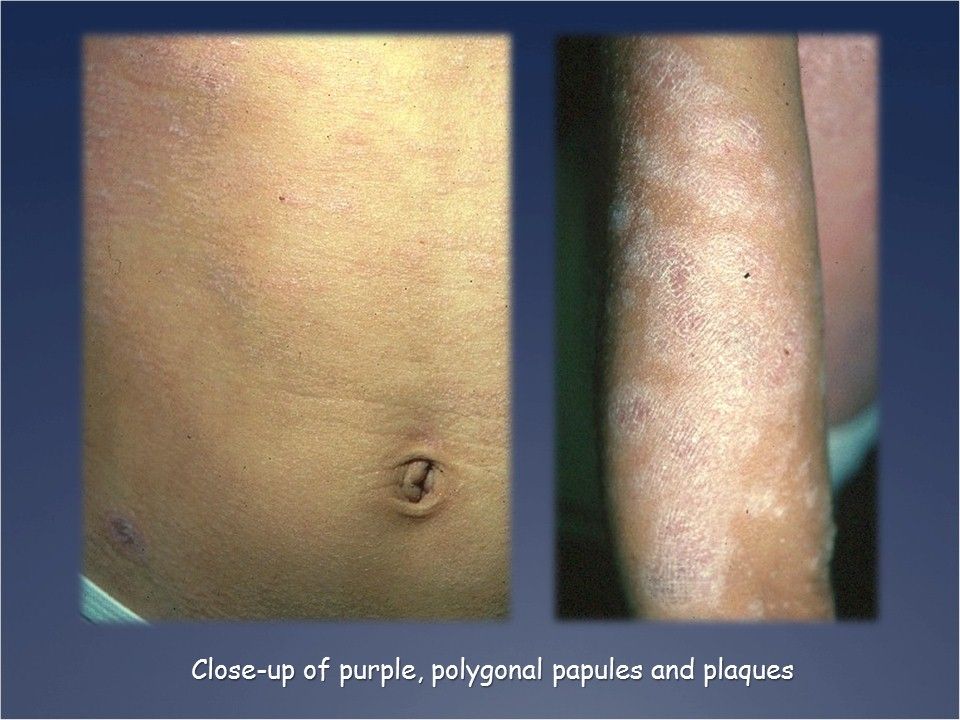 A Pruritic, Polygonal, Papular, Rash on a 10-year-old Boy