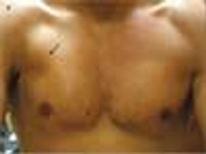 Pectoralis Major Partial Tear