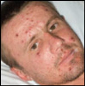 Young Man With a Mildly Pruritic Generalized Rash