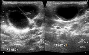 Bilateral Painless Swelling of the Neck in a 40-Year-Old Man 