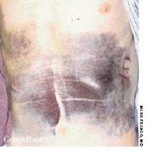 Disseminated Intravascular Coagulation