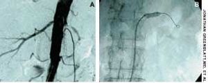 Renal Artery Stenosis Complicating Essential Hypertension