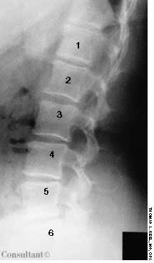 l6 vertebrae