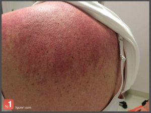Two Signs of Dermatomyositis