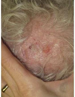 Recurrent Scalp Erosion in an Elderly Woman 