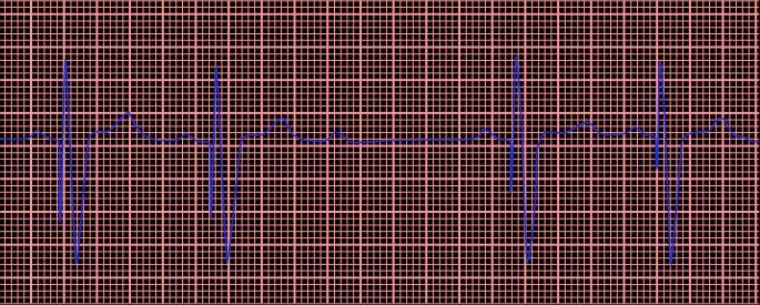 Pacemakers and AICDs: Interrogation Reports and Interpretation of EKGs