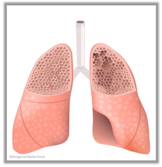 Dupilumab Achieves Outcomes In Phase 3 COPD Clinical Trial "Never ...