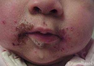 Oral Herpesvirus Infection With Impetigo Bullosa
