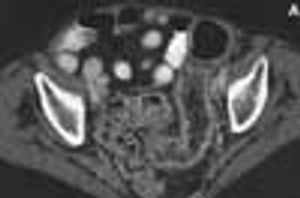 Pseudomembranous Colitis