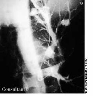 Pulmonary Arteriovenous Malformations