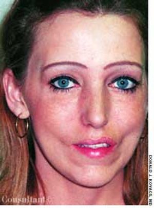 Facioscapulohumeral Muscular Dystrophy