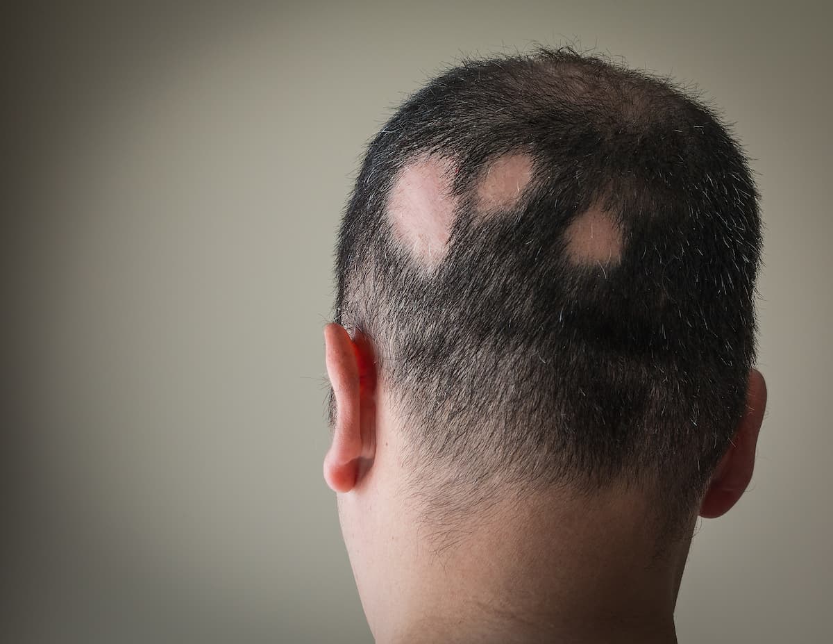 Alopecia Management in Primary Care: Expert Insights from ACP 2025 / Image credit: ©Alex Papp - ©Alex Papp - stock.adobe.com
