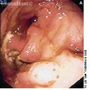 Suture Granuloma