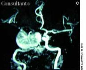 Giant Cavernous Sinus Aneurysm
